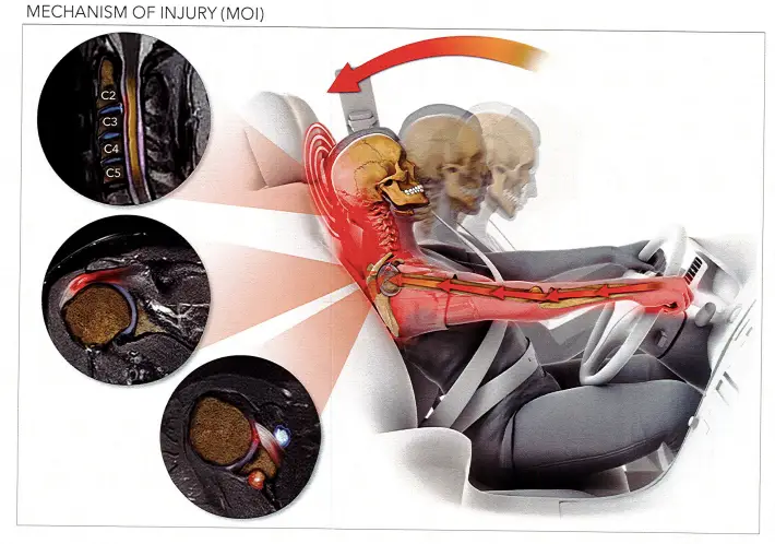 Thoracic Outlet Syndrom resulting from collision